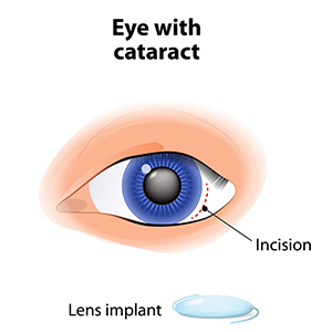 cataract surgery 00